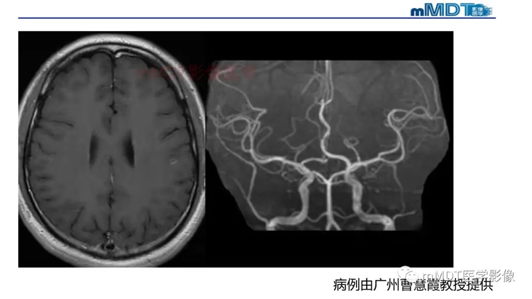 影像PPT - 【PPT】神经白塞病病例分析及综述-60 影像PPT - 【PPT】神经白塞病病例分析及综述-60