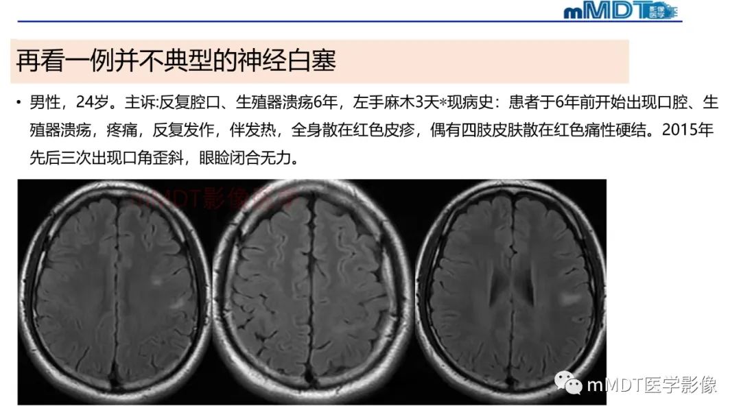 影像PPT - 【PPT】神经白塞病病例分析及综述-58 影像PPT - 【PPT】神经白塞病病例分析及综述-58