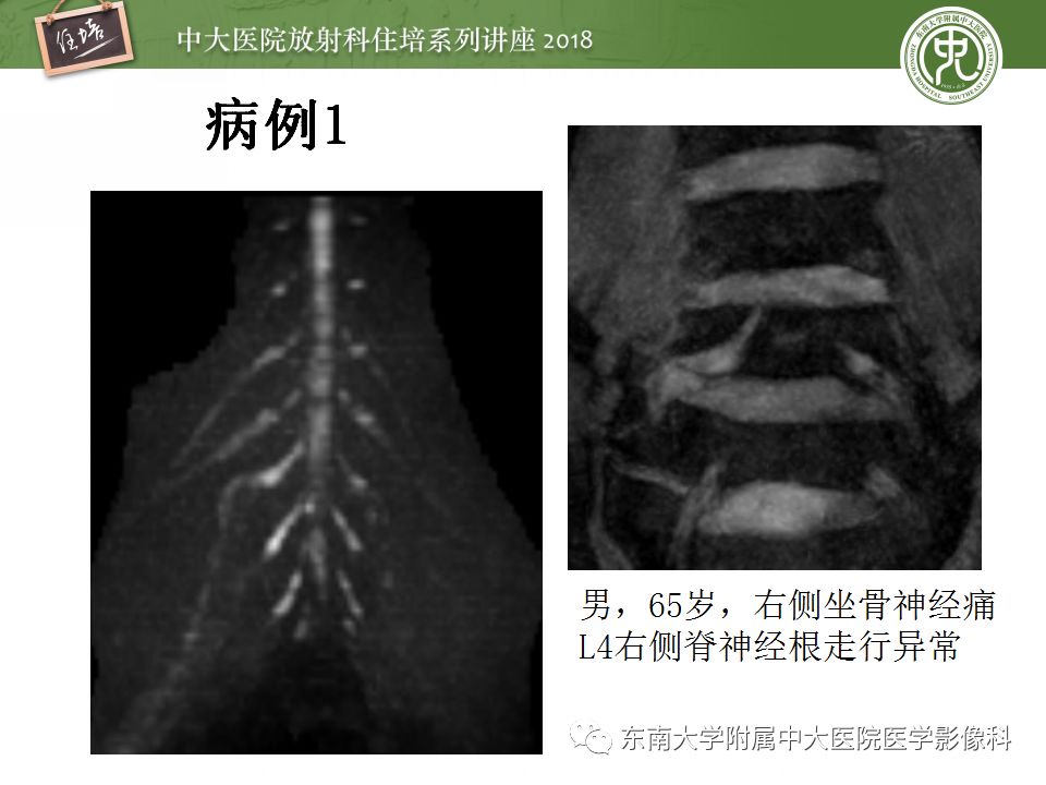 影像PPT - 【PPT】外周神经影像解剖及相关疾病简介-24
