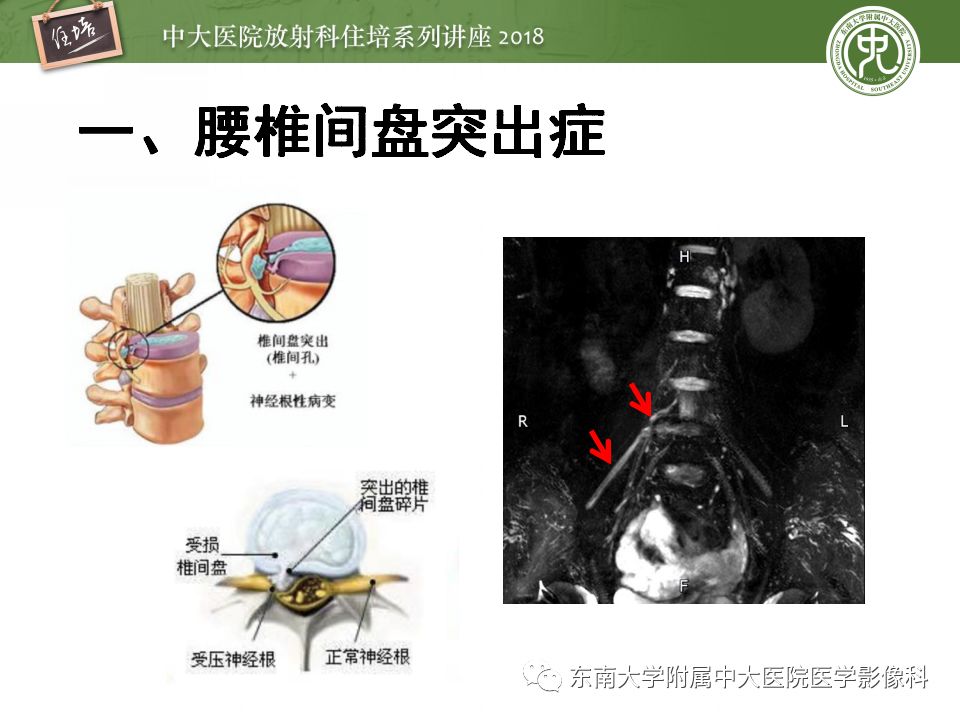 影像PPT - 【PPT】外周神经影像解剖及相关疾病简介-23