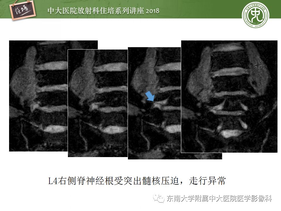影像PPT - 【PPT】外周神经影像解剖及相关疾病简介-25