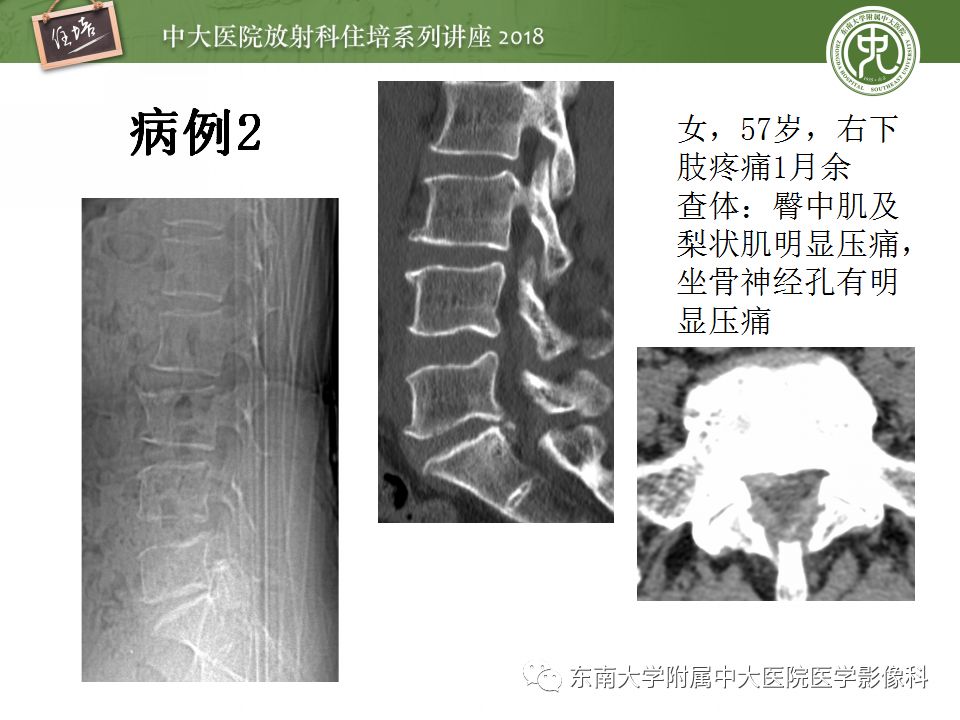 影像PPT - 【PPT】外周神经影像解剖及相关疾病简介-26