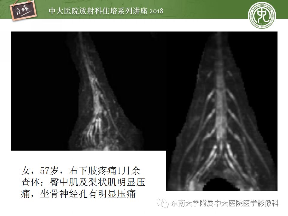 影像PPT - 【PPT】外周神经影像解剖及相关疾病简介-27