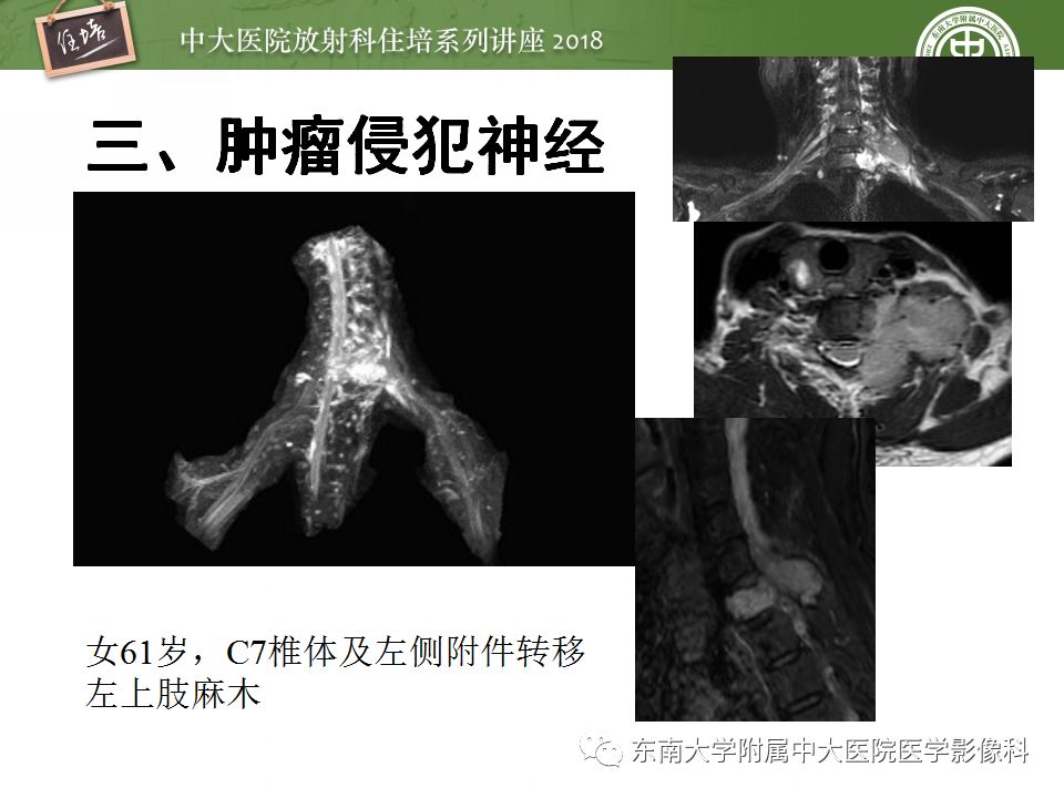 影像PPT - 【PPT】外周神经影像解剖及相关疾病简介-38