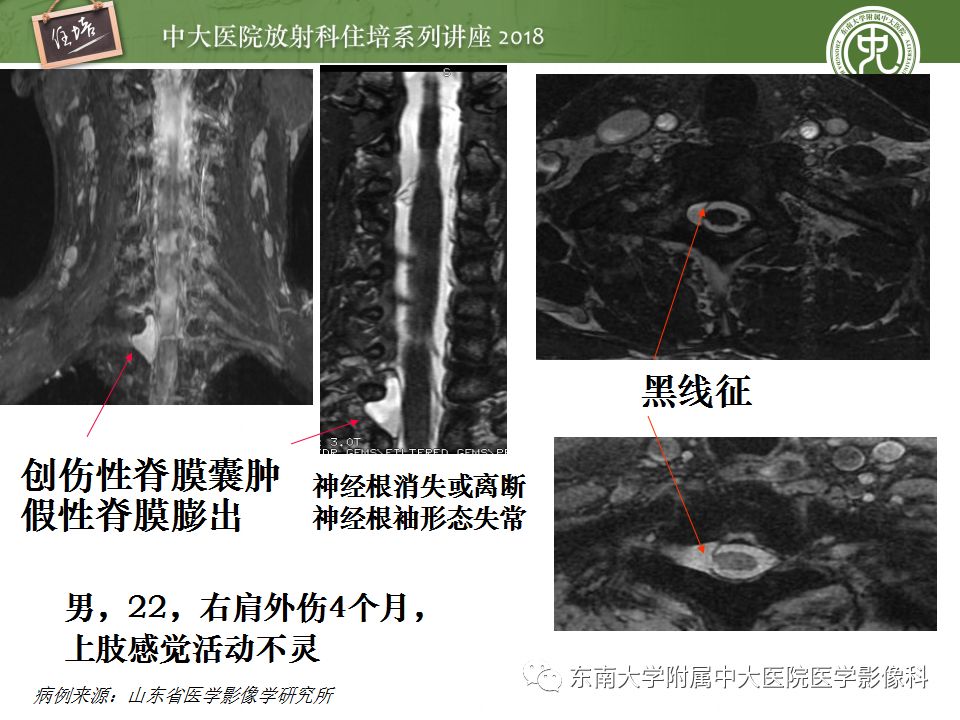 影像PPT - 【PPT】外周神经影像解剖及相关疾病简介-41