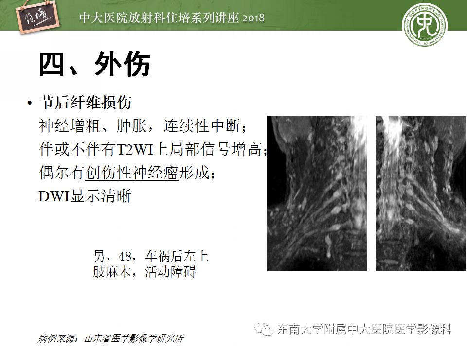 影像PPT - 【PPT】外周神经影像解剖及相关疾病简介-42