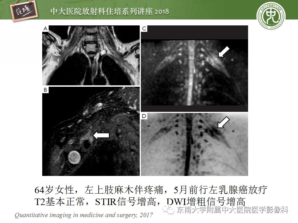 影像PPT - 【PPT】外周神经影像解剖及相关疾病简介-44