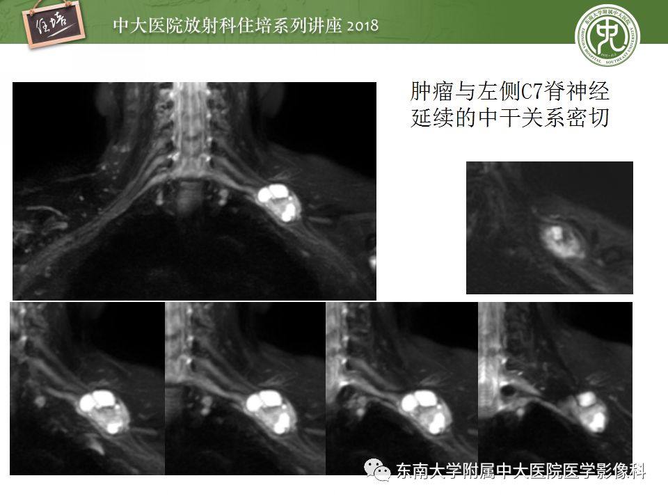 影像PPT - 【PPT】外周神经影像解剖及相关疾病简介-32