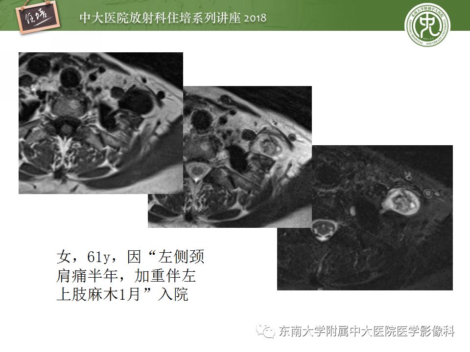 影像PPT - 【PPT】外周神经影像解剖及相关疾病简介-31