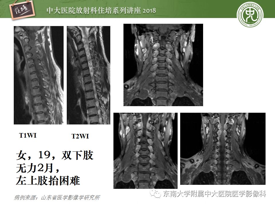 影像PPT - 【PPT】外周神经影像解剖及相关疾病简介-34