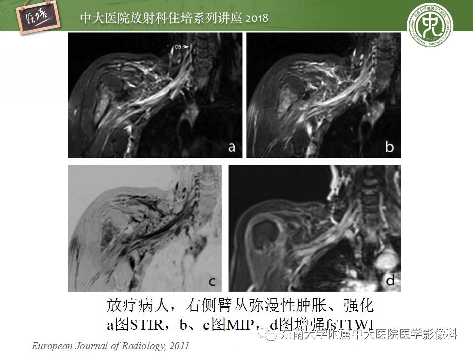 影像PPT - 【PPT】外周神经影像解剖及相关疾病简介-45