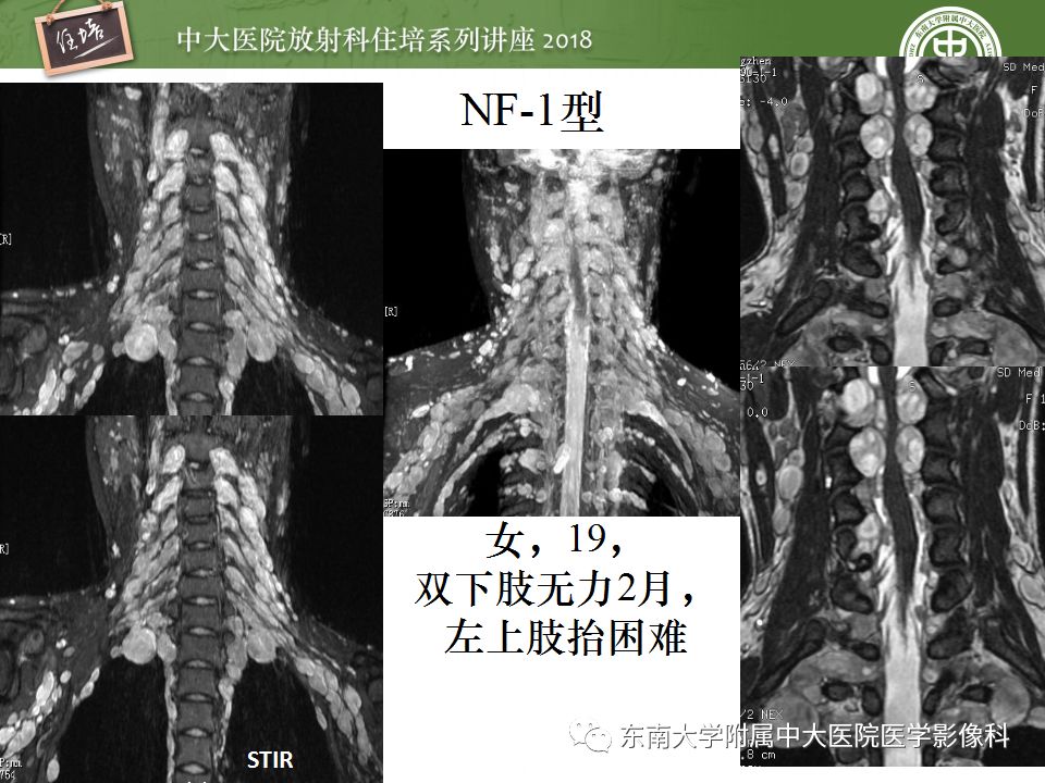 影像PPT - 【PPT】外周神经影像解剖及相关疾病简介-35