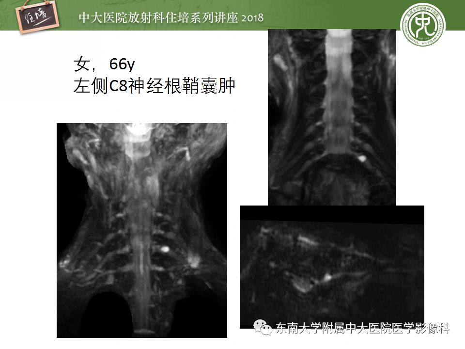 影像PPT - 【PPT】外周神经影像解剖及相关疾病简介-48