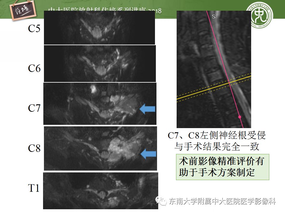 影像PPT - 【PPT】外周神经影像解剖及相关疾病简介-39