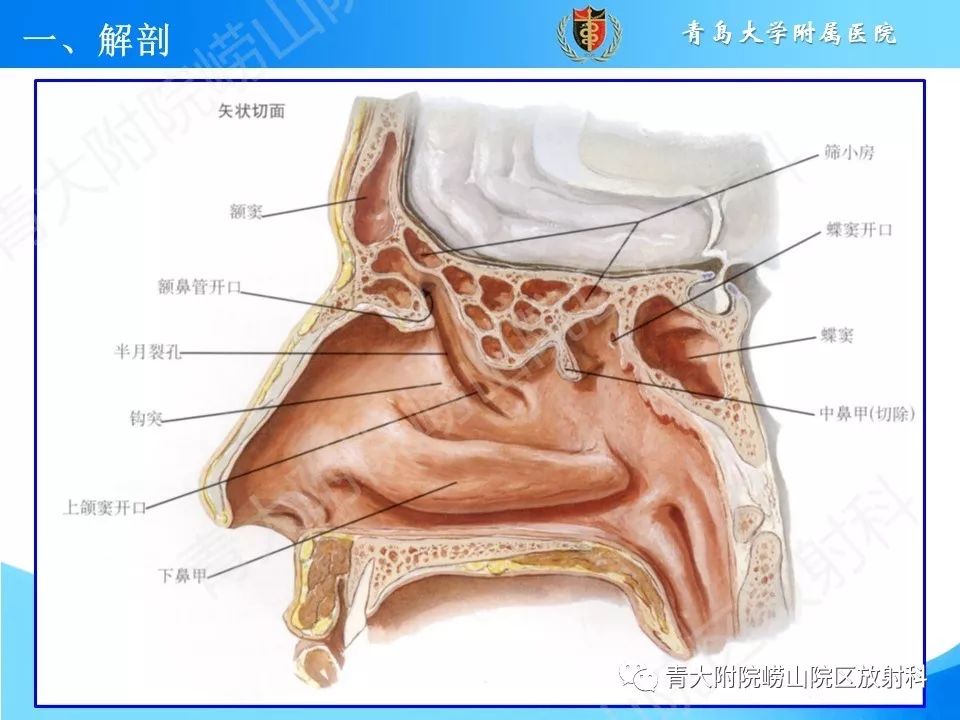 影像PPT - 【PPT】鼻和鼻窦-6