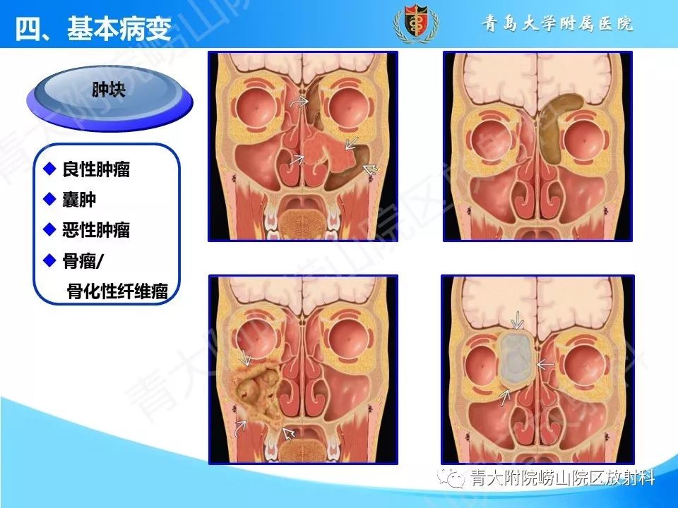 影像PPT - 【PPT】鼻和鼻窦-17