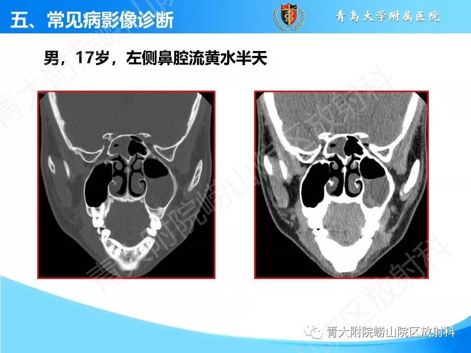 影像PPT - 【PPT】鼻和鼻窦-28