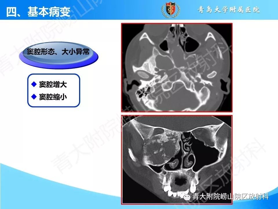 影像PPT - 【PPT】鼻和鼻窦-19