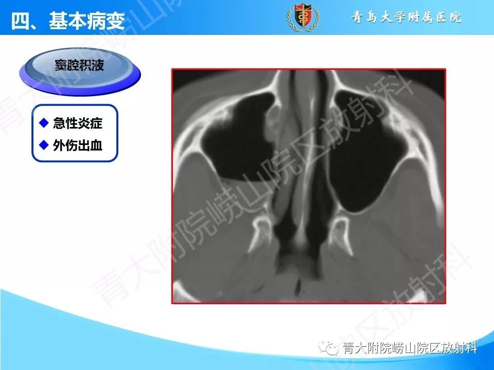 影像PPT - 【PPT】鼻和鼻窦-18