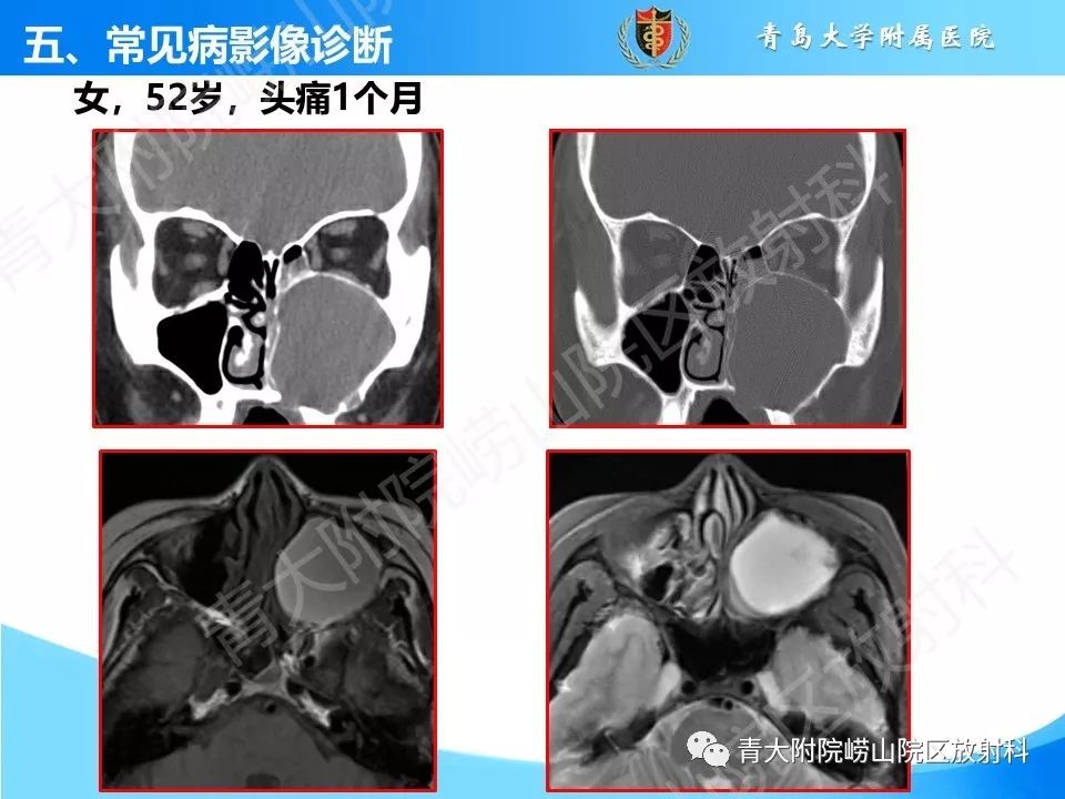 影像PPT - 【PPT】鼻和鼻窦-37