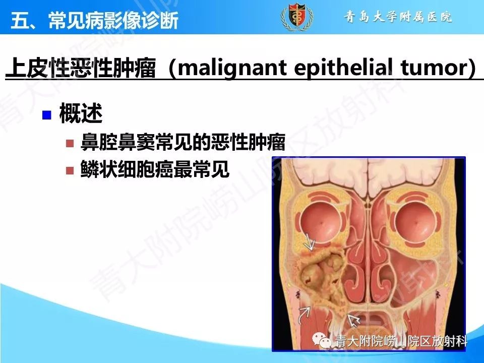 影像PPT - 【PPT】鼻和鼻窦-44