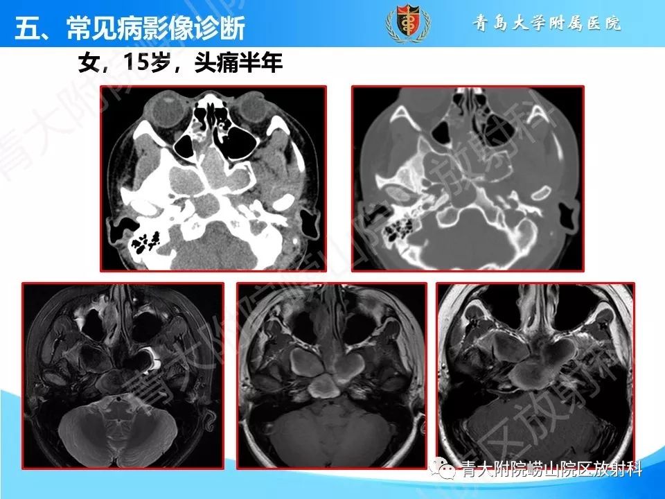 影像PPT - 【PPT】鼻和鼻窦-35