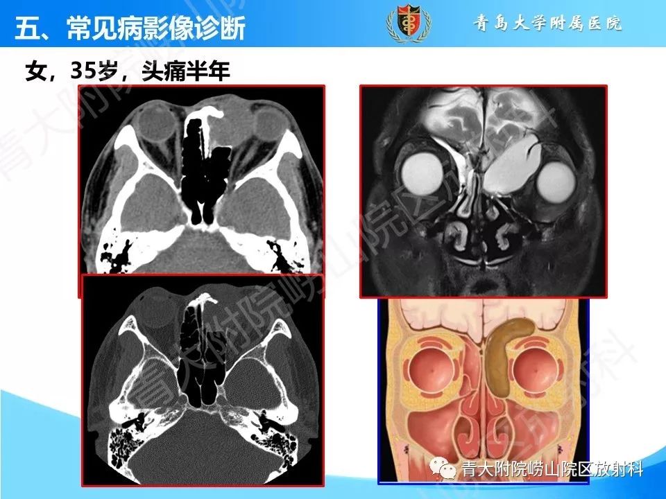 影像PPT - 【PPT】鼻和鼻窦-34