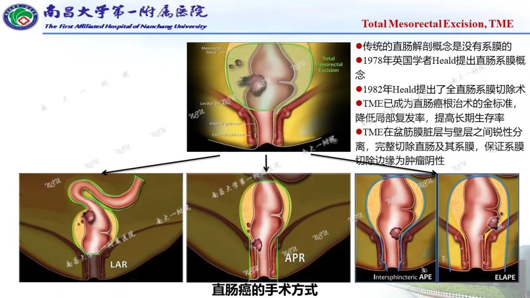 影像PPT - 【PPT】直肠癌MRI分期-6