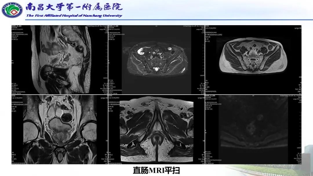 影像PPT - 【PPT】直肠癌MRI分期-9