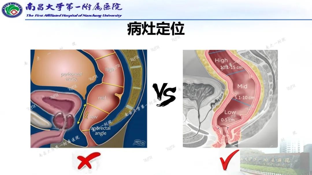 影像PPT - 【PPT】直肠癌MRI分期-13
