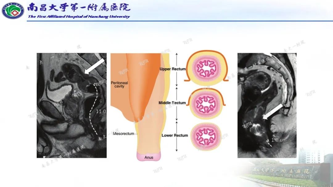 影像PPT - 【PPT】直肠癌MRI分期-14