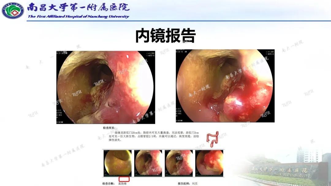 影像PPT - 【PPT】直肠癌MRI分期-10