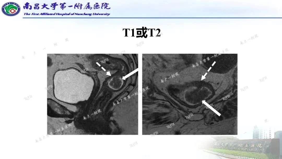 影像PPT - 【PPT】直肠癌MRI分期-17