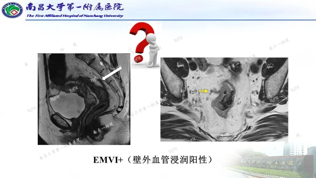 影像PPT - 【PPT】直肠癌MRI分期-22