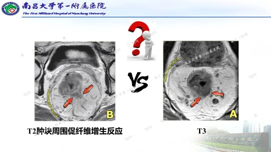 影像PPT - 【PPT】直肠癌MRI分期-19