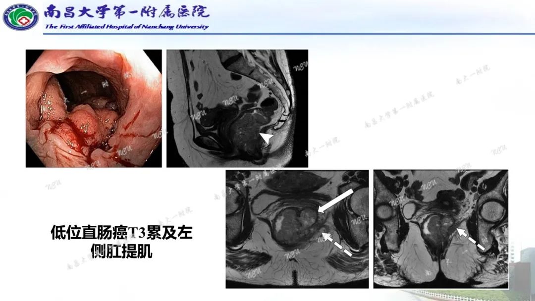 影像PPT - 【PPT】直肠癌MRI分期-21