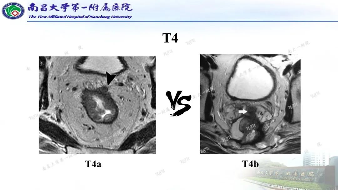 影像PPT - 【PPT】直肠癌MRI分期-20