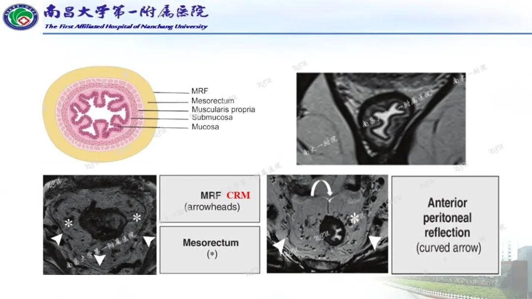 影像PPT - 【PPT】直肠癌MRI分期-15