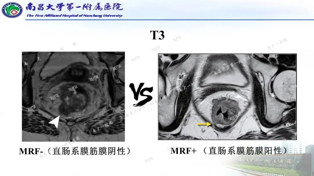 影像PPT - 【PPT】直肠癌MRI分期-18