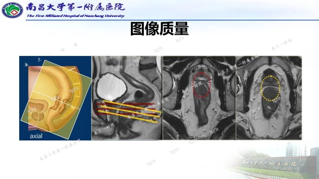 影像PPT - 【PPT】直肠癌MRI分期-12