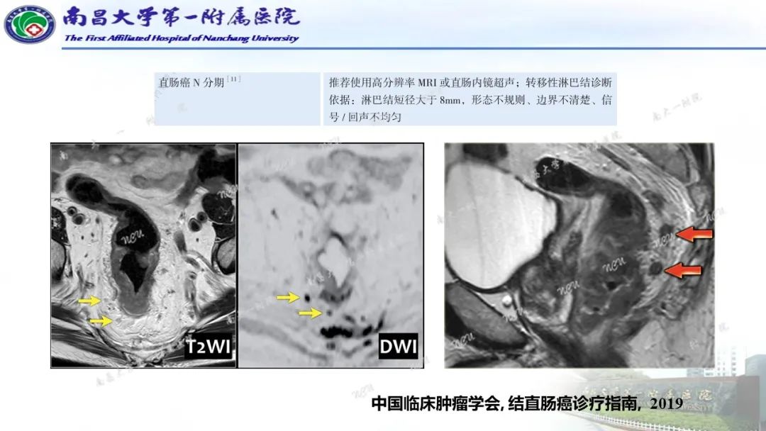 影像PPT - 【PPT】直肠癌MRI分期-24