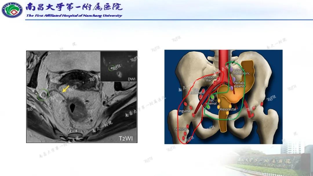影像PPT - 【PPT】直肠癌MRI分期-26
