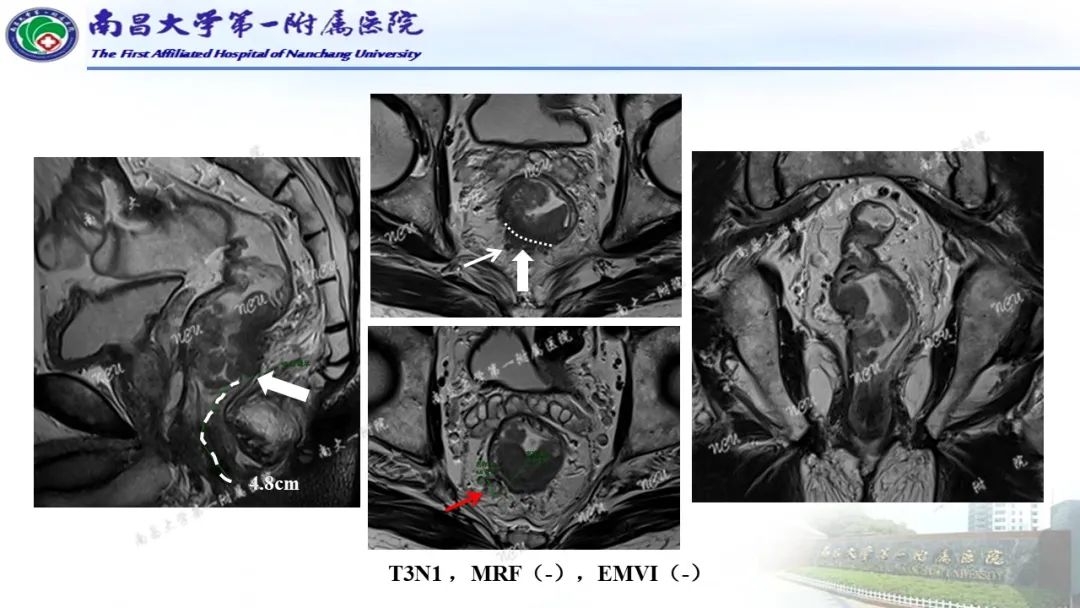 影像PPT - 【PPT】直肠癌MRI分期-28