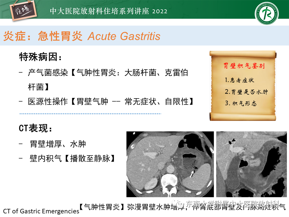 影像PPT - 【PPT】常见胃部急症的影像学征象分析-9