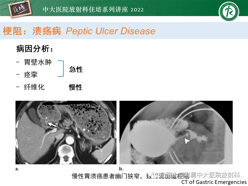 影像PPT - 【PPT】常见胃部急症的影像学征象分析-12