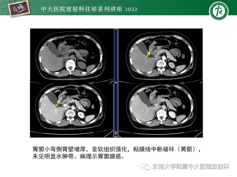 影像PPT - 【PPT】常见胃部急症的影像学征象分析-8