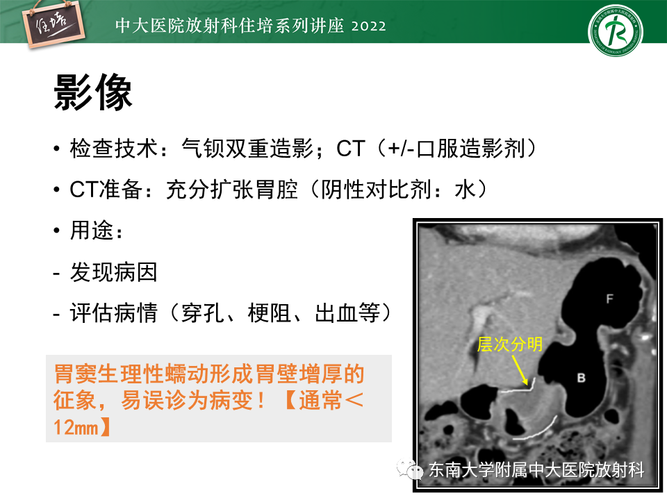 影像PPT - 【PPT】常见胃部急症的影像学征象分析-5