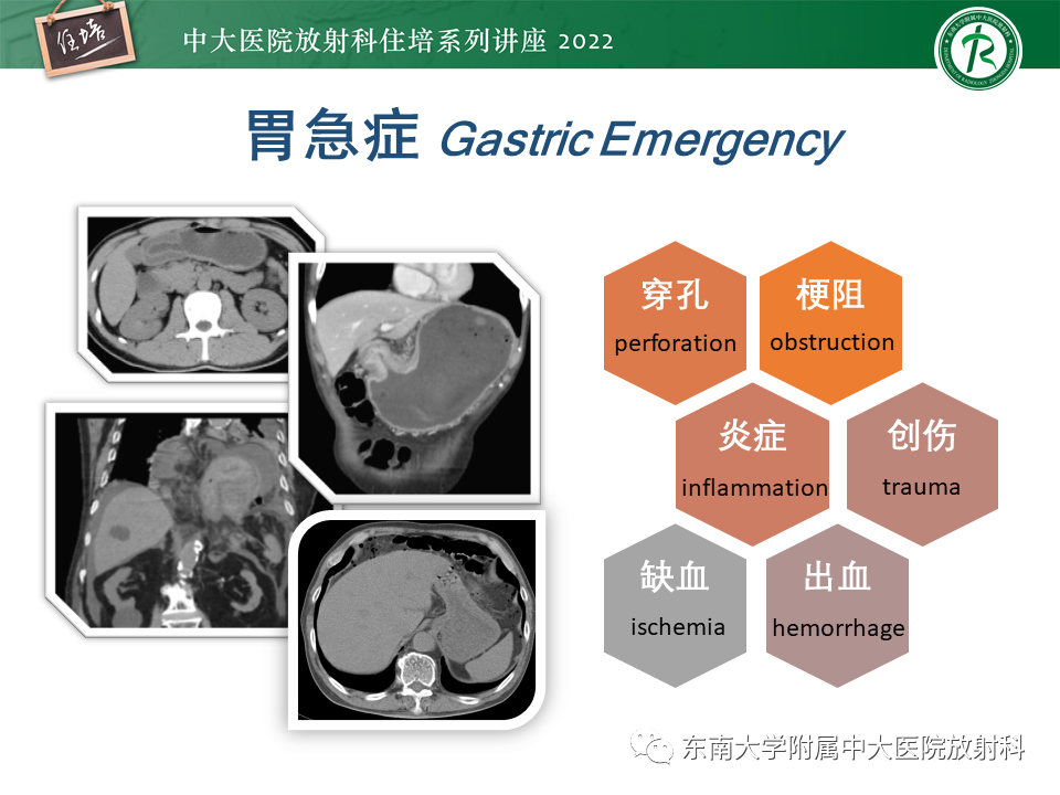 影像PPT - 【PPT】常见胃部急症的影像学征象分析-6