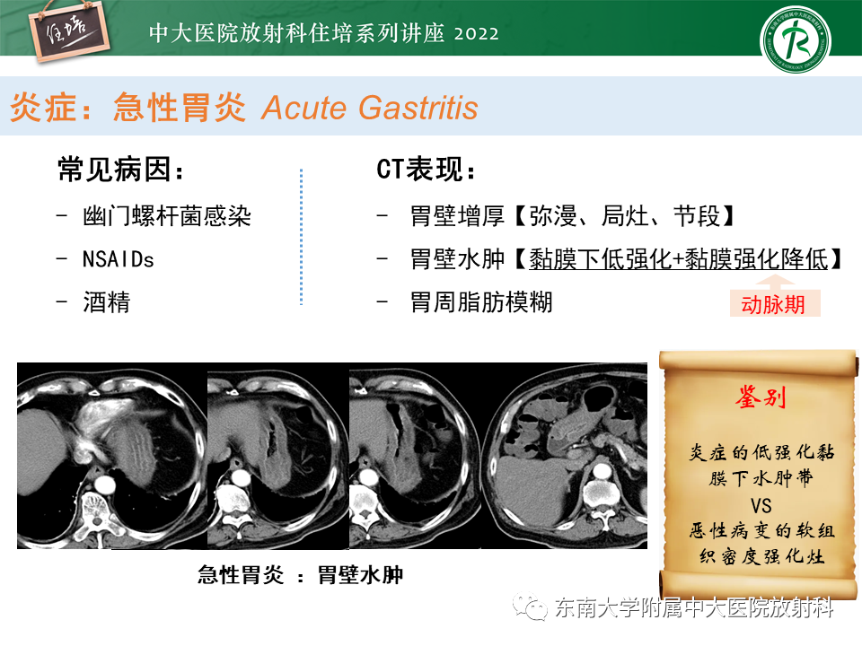 影像PPT - 【PPT】常见胃部急症的影像学征象分析-7