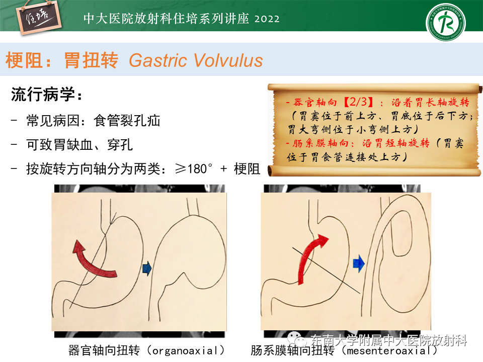 影像PPT - 【PPT】常见胃部急症的影像学征象分析-13